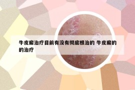 牛皮廨治療目前有沒(méi)有徹底根治的 牛皮廨的的治療