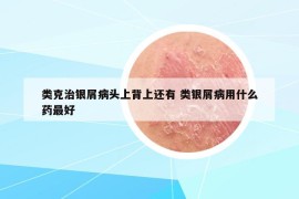 類克治銀屑病頭上背上還有 類銀屑病用什么藥最好