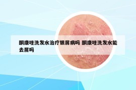 酮康唑洗發(fā)水治療銀屑病嗎 酮康唑洗發(fā)水能去屑嗎