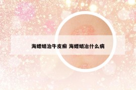 海螵蛸治牛皮癬 海螵蛸冶什么病