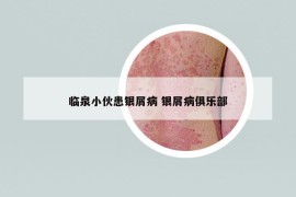 臨泉小伙患銀屑病 銀屑病俱樂部