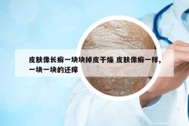 皮膚像長(zhǎng)癬一塊塊掉皮干燥 皮膚像癬一樣,一塊一塊的還癢