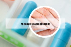 牛皮癬會(huì)引起腿腫和痛嗎