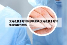 復方氨肽素片對頭部銀屑病 復方氨肽素片對銀屑病有作用嗎