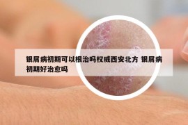 銀屑病初期可以根治嗎權(quán)威西安北方 銀屑病初期好治愈嗎
