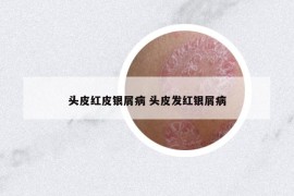 頭皮紅皮銀屑病 頭皮發(fā)紅銀屑病