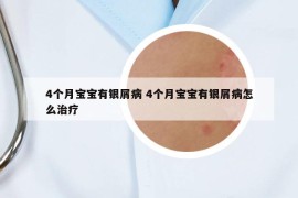 4個月寶寶有銀屑病 4個月寶寶有銀屑病怎么治療
