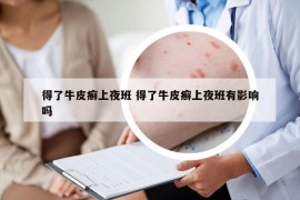 得了牛皮癬上夜班 得了牛皮癬上夜班有影響嗎
