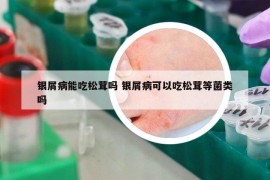 銀屑病能吃松茸嗎 銀屑病可以吃松茸等菌類嗎