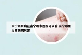 南寧銀屑病在南寧哪家醫(yī)院可以看 南寧哪里治皮膚病厲害