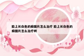 臉上長白色的癬圖片怎么治療 臉上長白色的癬圖片怎么治療啊
