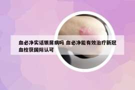 血必凈實(shí)話銀屑病嗎 血必凈能有效治療新冠血栓獲國(guó)際認(rèn)可