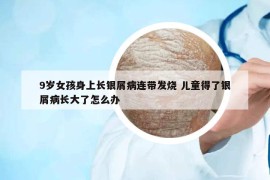 9歲女孩身上長(zhǎng)銀屑病連帶發(fā)燒 兒童得了銀屑病長(zhǎng)大了怎么辦