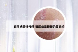 銀屑病是特慢嗎 銀屑病是慢慢的蔓延嗎