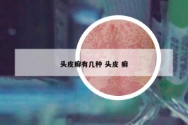 頭皮癬有幾種 頭皮 癬
