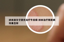 納米準(zhǔn)分子激光治療牛皮癬 納米治療銀屑病效果怎樣
