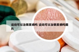 運(yùn)動(dòng)可以治銀屑病嗎 運(yùn)動(dòng)可以治銀屑病嗎圖片