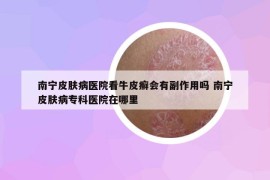 南寧皮膚病醫(yī)院看牛皮癬會有副作用嗎 南寧皮膚病?？漆t(yī)院在哪里