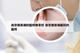 南京銀屑病的醫(yī)院哪家好 南京銀屑病最好的醫(yī)院