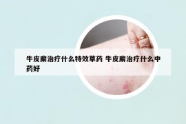 牛皮廨治療什么特效草藥 牛皮廨治療什么中藥好