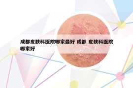 成都皮膚科醫(yī)院哪家最好 成都 皮膚科醫(yī)院哪家好