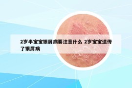 2歲半寶寶銀屑病要注意什么 2歲寶寶遺傳了銀屑病