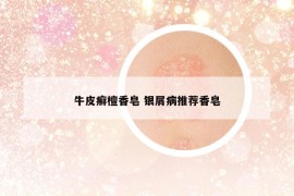 牛皮癬檀香皂 銀屑病推薦香皂