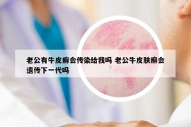 老公有牛皮癬會(huì)傳染給我嗎 老公牛皮膚癬會(huì)遺傳下一代嗎