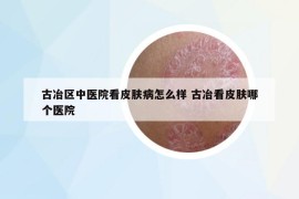 古冶區(qū)中醫(yī)院看皮膚病怎么樣 古冶看皮膚哪個(gè)醫(yī)院