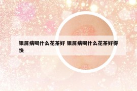 銀屑病喝什么花茶好 銀屑病喝什么花茶好得快