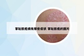 掌趾膿皰病有那些癥狀 掌趾膿皰的圖片