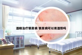 酒精治療銀屑病 銀屑病可以用酒擦嗎