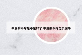 牛皮癬不癢是不是好了 牛皮癬不癢怎么回事
