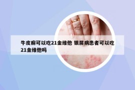 牛皮癬可以吃21金維他 銀屑病患者可以吃21金維他嗎