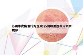 蘇州牛皮癬治療好醫(yī)院 蘇州哪里醫(yī)院治銀屑病好