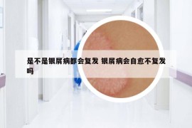 是不是銀屑病都會復發(fā) 銀屑病會自愈不復發(fā)嗎