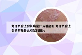 為什么臉上會長癬是什么引起的 為什么臉上會長癬是什么引起的圖片