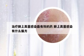 治療腳上真菌感染最有效的藥 腳上真菌感染有什么偏方