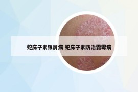 蛇床子素銀屑病 蛇床子素防治霜霉病