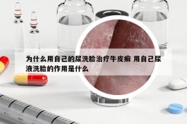 為什么用自己的尿洗臉治療牛皮癬 用自己尿液洗臉的作用是什么
