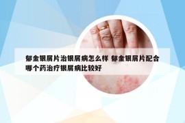 郁金銀屑片治銀屑病怎么樣 郁金銀屑片配合哪個(gè)藥治療銀屑病比較好