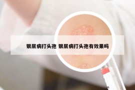 銀屑病打頭孢 銀屑病打頭孢有效果嗎