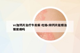 vc加鈣片治療牛皮癬 吃維c和鈣片能根治銀屑病嗎