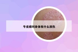 牛皮癬對(duì)身體有什么損傷