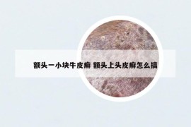 額頭一小塊牛皮癬 額頭上頭皮癬怎么搞