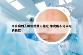 牛皮癬的人哪些蔬菜不能吃 牛皮癬不可以吃的蔬菜