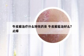 牛皮廨治療什么特效藥膏 牛皮廨能治好么?止癢