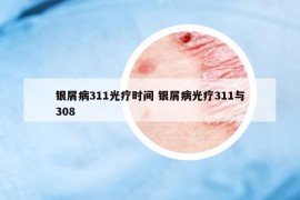 銀屑病311光療時間 銀屑病光療311與308