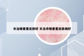 長(zhǎng)治哪里看皮膚好 長(zhǎng)治市哪里看皮膚病好