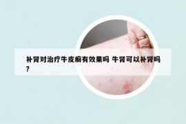 補(bǔ)腎對(duì)治療牛皮癬有效果嗎 牛腎可以補(bǔ)腎嗎?
